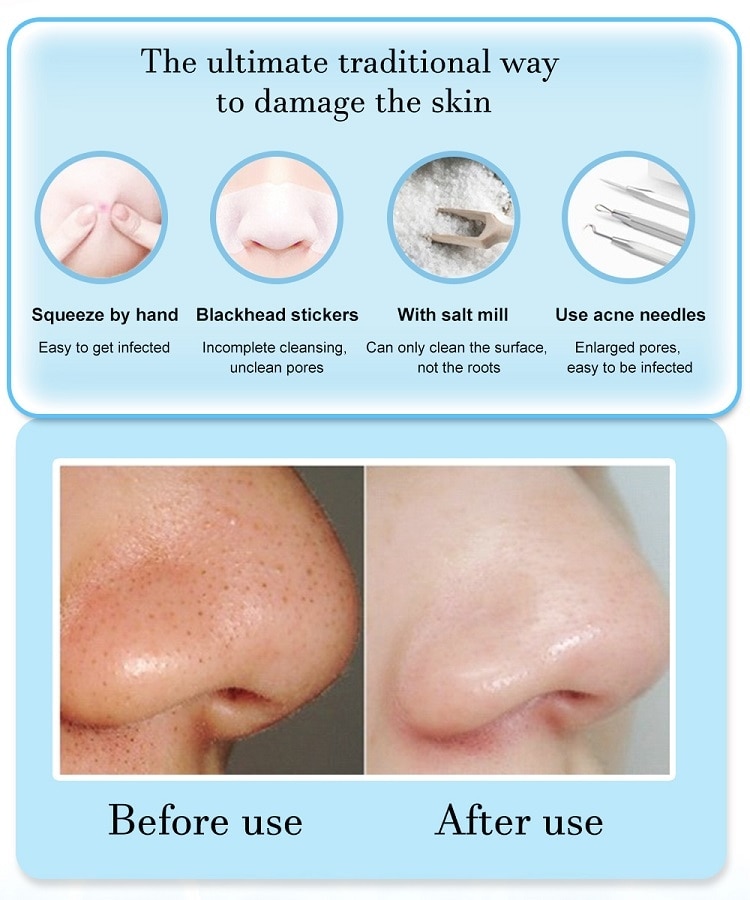 Vacuum Blackhead Removal